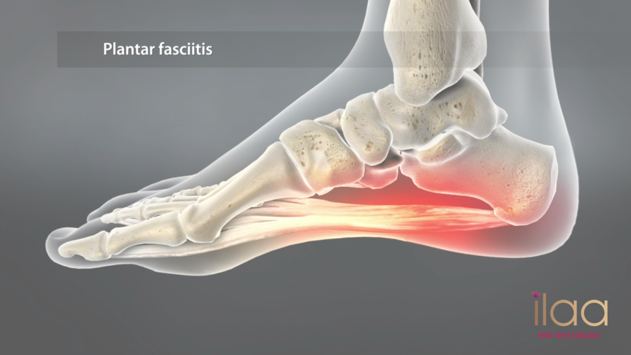 Professional Plantar fasciitis Treatment in Adyar, Chennai - ilaa