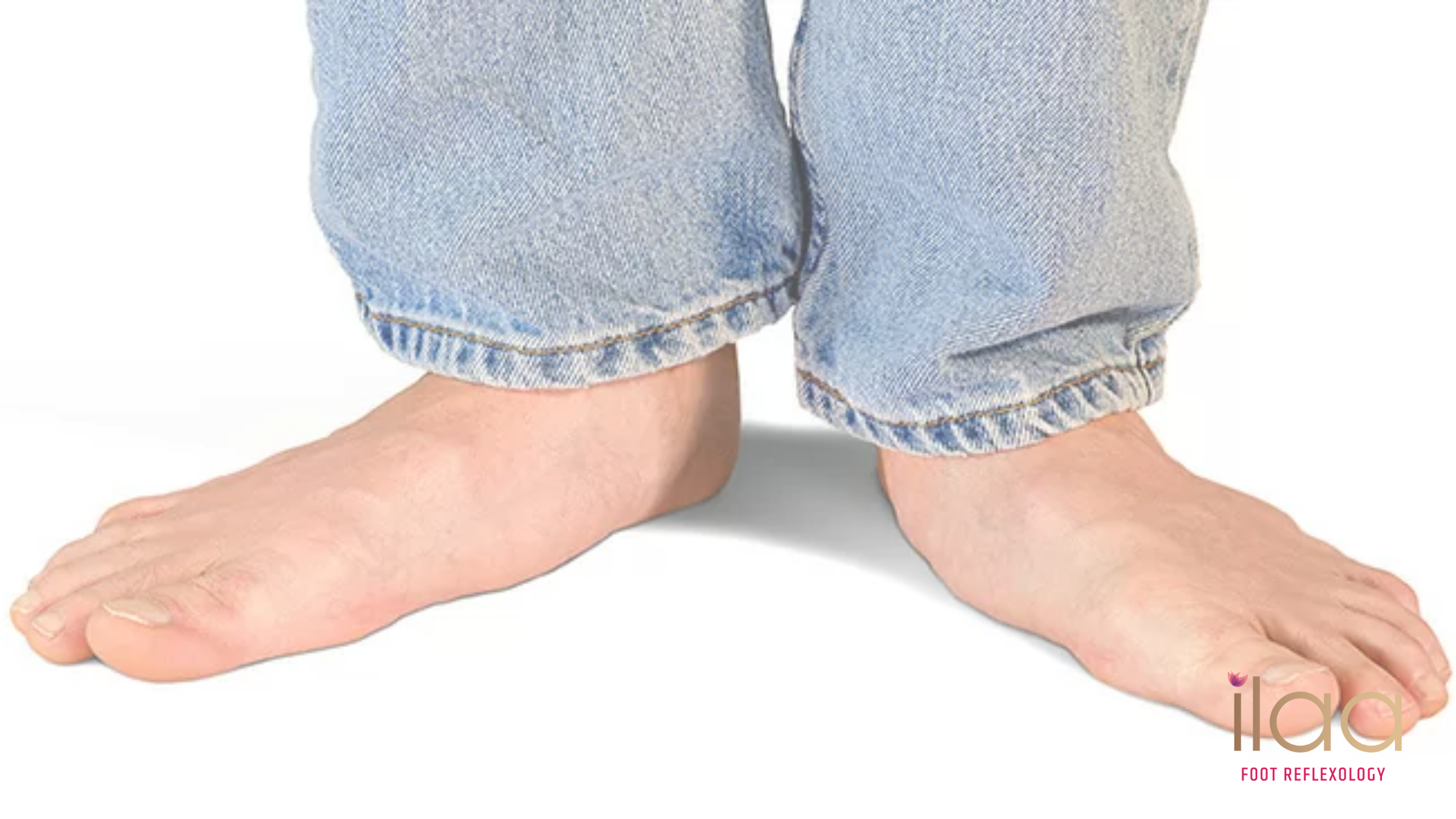 Expert Treatment for Flat Feet Correction in Adyar, Chennai - ilaa