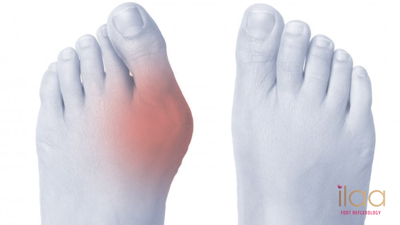 Best Footcare Packages to Treat Bunion in Adyar, Chennai - ilaa